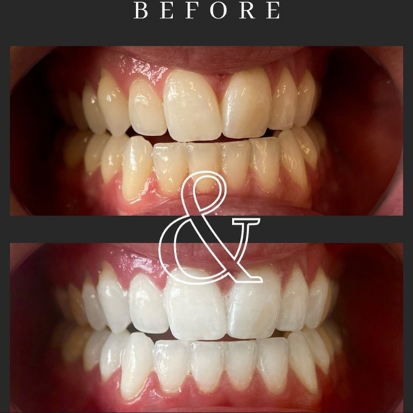 Teeth Whitening Pens. (2) 16% HP. Up to 8 Shades Whiter after the first use. - Picture 4 of 4